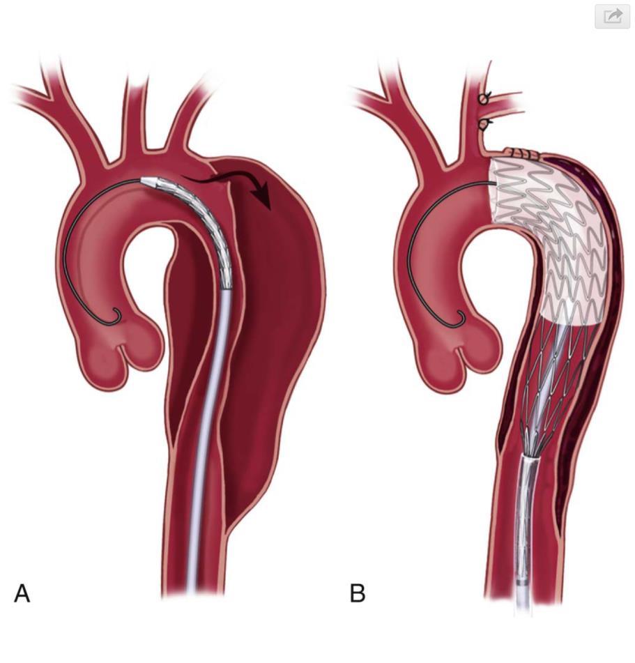 THORACIC