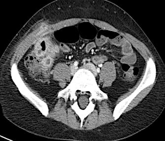 Εικόνα: Περιτυφλική συλλογή σε νόσο του Crohn με επινέμηση στην πύελο