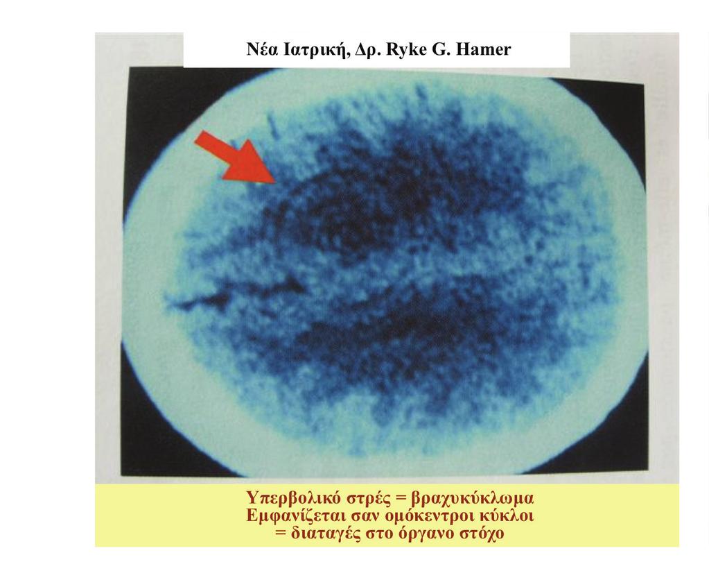 αντιστοιχεί σε αυτήν την διαδικασία, μετά την επίλυση του στρές απώλειας του ζωτικού μου χώρου, ενός στρές που διήρκεσε όμως πολύ. Παρόμοια με τις κράμπες η την πνευμονική εμβολή.