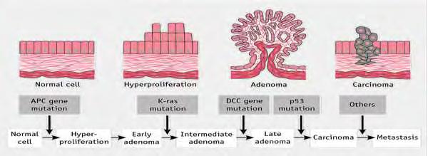 Carcinoma) συμμετέχουν σε πολλά στάδια του μετασχηματισμού από φυσιολογικό εντερικό βλεννογόνο σε μεταστατικό καρκίνωμα (εικόνα 1.2). Εικόνα 1.2: Μοντέλο Καρκινογένεσης Παχέος Εντέρου [122] 1.
