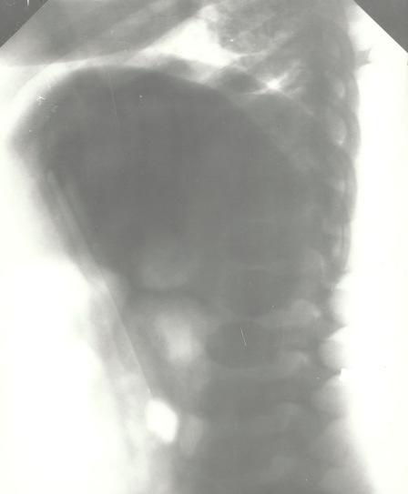 1. Lüsosomaalsed haiguste diagnostika Luude düsostoos e. dysostosis multplex ovaalse kujuga lülikehad eesmine keel 1.