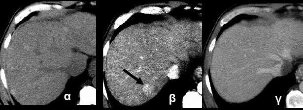 Εικόνα 1: Ελικοειδής αξονική τομογραφία σε ασθενή 50 ετών με κίρρωση και ΗΚΚ (α), η οποία αναδεικνύει