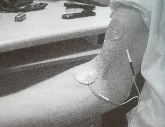 απάντηση. Σε αυτήν την περίπτωση χρησιμοποιούνται όροι όπως ηλεκτρικές ορθώσεις ή νευρικές προθέσεις. Έμμεσο αποτέλεσμα είναι η ενδυνάμωση μυών. 2.1 