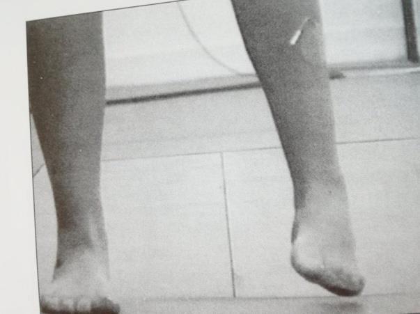 Φαίνεται να γίνεται πλήρης εκκένωση με εφαρμογή του ερεθισμού 8,6 ωρών ημερησίως.
