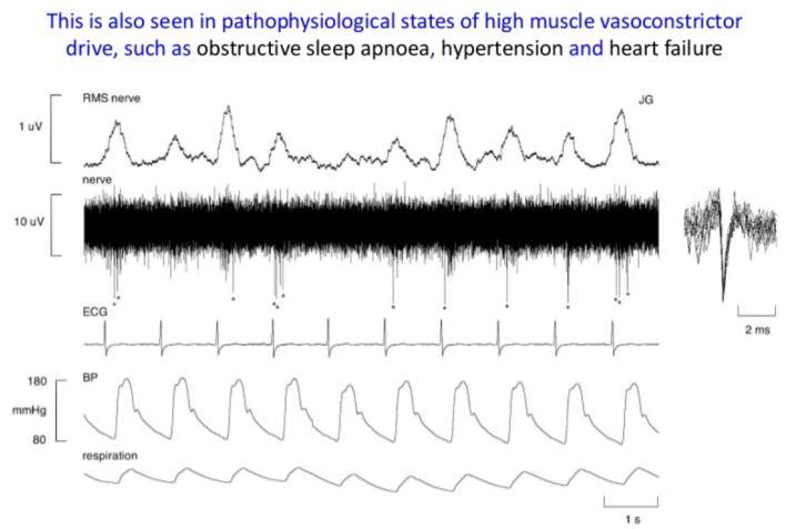 net/insidescientific /microneurography-recording-nerve-trafficvia-intraneural-microelectrodes-inhumansadi Microneurographic