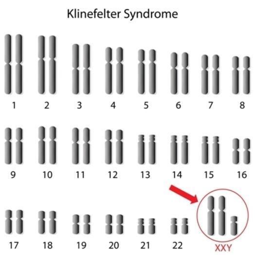 Κφριεσ ςυννοςθρότθτεσ επί ςυνδρόμου Klinefelter Πακολογία SMR (95% CI) Κφριεσ εκδθλϊςεισ Καρδιαγγειακζσ νόςοι 1,3 (1,1 1,5) Νόςοι των εγκεφαλικϊν αγγείων 2,2 (1,6 3,0) Μεταβολικζσ διαταραχζσ 4,8