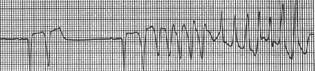 FACTORI DE RISC: -QTc lung congenital -Boli cardiace -Medicaţie ce alungeşte QT -Dezechilibre hidro-electrolitice Stimul simpatic (ESV) QTc lung : Femei > 470 Bărbaţi >