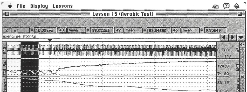 80 Lucrări practice de fiziologie Electrozii pentru ECG se aşează pe membre în ordinea: alb membrul superior drept, roşu membrul inferior stâng şi negru membrul inferior drept. 3.