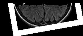 αντίστοιχων βλαβών και εξωγεφυρικά (extrapontine myelinolysis), όπως στα βασικά γάγγλια, στο φλοιό, στον ιππόκαμπο και αλλού Θεωρείται ότι η