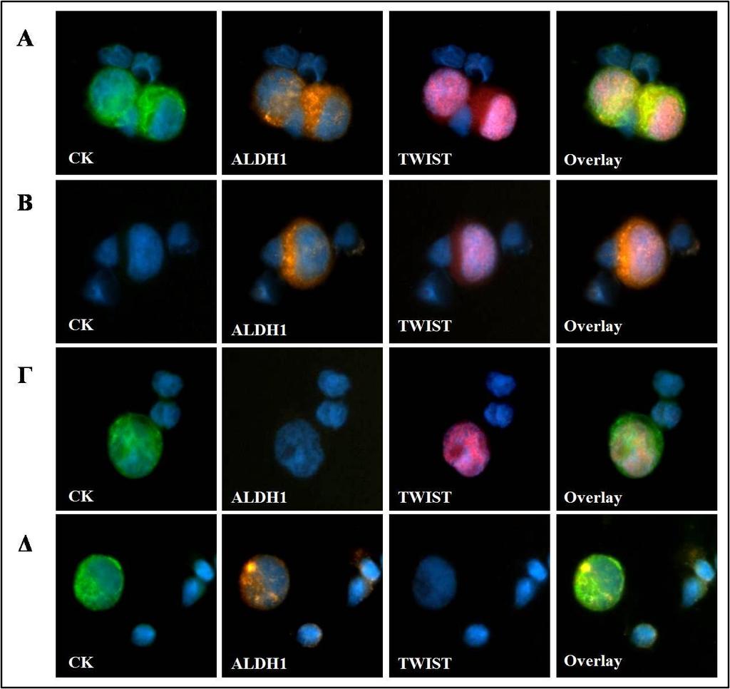 154 Εικόνα 53: Πειράματα ελέγχου για τη συνέκφραση των μορίων CK, ALDH1 και TWIST σε αναμεμιγμένα κύτταρα ελέγχου HepG2 με PBMCs φυσιολογικών αιμοδοτών, ARIOL, 200X.