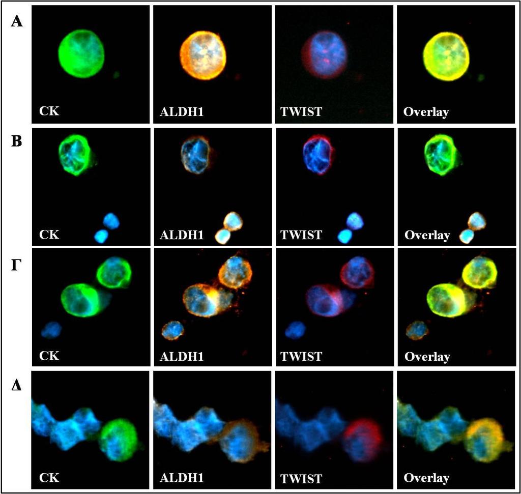 156 Εικόνα 54: Αντιπροσωπευτικές μικρογραφίες των φαινοτυπικά διαφορετικών ΚΚΚ ανάμεσα σε φυσιολογικά κύτταρα των ασθενών με ΚΑΠΕ, ARIOL, 400X.