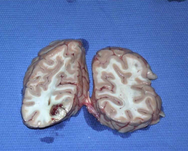 Слика 16. Инфаркт мозга (infarktus cerebri).