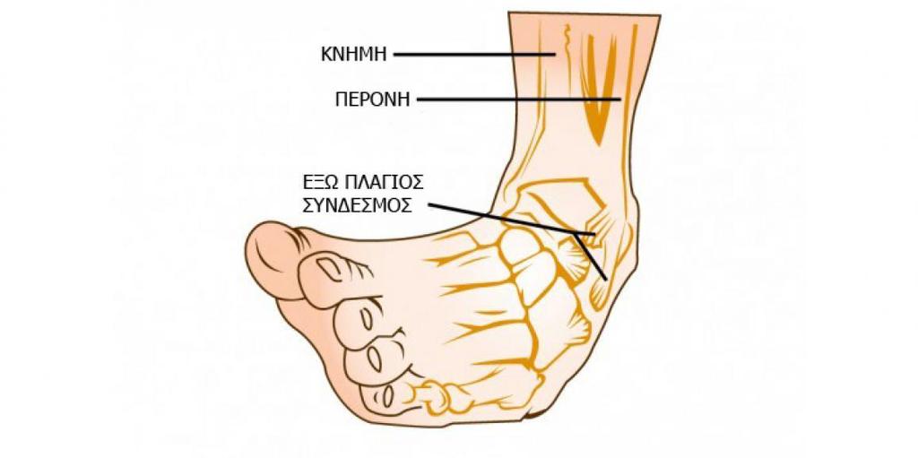 ΠΟΔΟΚΝΗΜΙΚΉ ΔΙΆΣΤΡΕΜΜΑ Χαρακτηρίζετε από την ρήξη ή την διάταση των συνδέσμων που σταθεροποιούν την ποδοκνημική άρθρωση.