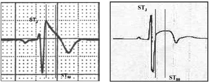 Εικόνα 10. Μέθοδος της «αποφυγής της ουράς» στη δια χειρός μέτρηση του QT. Εικόνα 11.