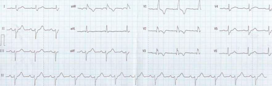 RBBB and