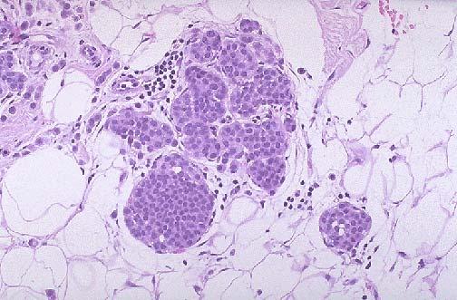 κύτταρα του όγκου (LCIS). Εικόνα 27.