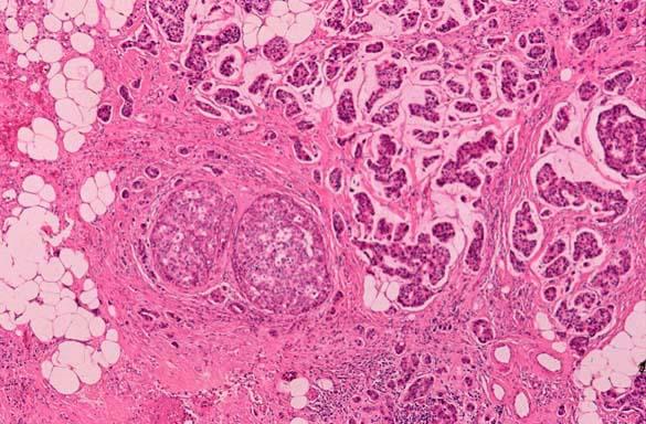 Πορογενές μη διηθητικό καρκίνωμα ( DCIS ) Το μη διηθητικό πορογενές καρκίνωμα του μαστού είναι πολύ πιο συχνό από το λοβιακό καρκίνωμα in situ.