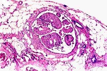 Θηλώδης τύπος : Υπάρχει άναρχος ενδοαυλικός πολλαπλασιασμός των κυττάρων, που προσλαμβάνει τη μορφή θηλωδών προσεκβολών, με τυπικούς αγγειοσυνδετικούς άξονες.