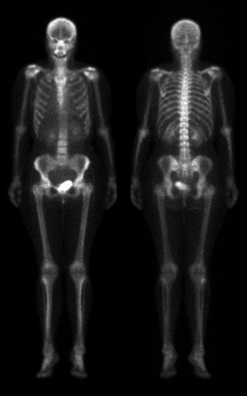 Κλασικά Ραδιοφάρµακα του του 99m Tc O HO P HO P O O OH O P O Tc OH O O P OH O OH Technetium ( 99m Tc) Medronate απεικονίζει τον σκελετό οστικές µεταστάσεις καρκίνου, οστεοµυελίτιδα, ασθένεια του