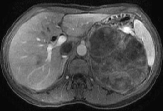 Καρκίνος του φλοιού των επινεφριδίων Καρκίνος φλοιού επινεφριδίων, μαγνητική τομογραφία μετά από iv έγχυση σκιαγραφικής