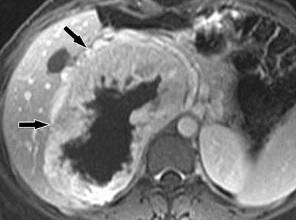 σκιαγραφικού (MRI) δείχνει ένα ευμέγεθες φαιοχρωμοκύττωμα δεξιά με πλούσιο περιφερικό