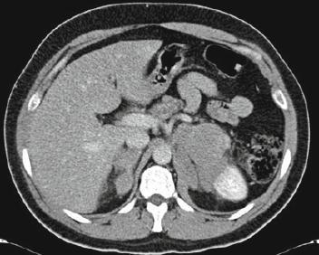 Λέμφωμα επινεφριδίων Αξονική τομογραφία μετά από iv έγχυση σκιαγραφικής ουσίας δείχνει αμφοτερόπλευρη προσβολή των επινεφριδίων από λέμφωμα