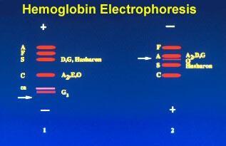 Αιμοσφαιρινοπάθειες Ηλεκτροφόρηση Αιμοσφαιρίνης Hb A: 95%