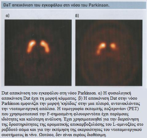 Η αξονική τομογραφία (ΙΤ) και η μαγνητική τομογραφία (MR) εγκεφάλου δεν είναι απαραίτητες για την διάγνωση της νόσου.