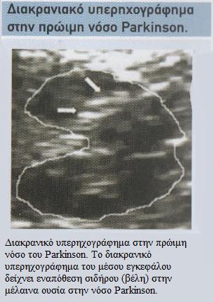 5.2 Διαγνωστικές Εξετάσεις Παραθέτονται παρακάτω ορισμένες διαγνωστικές εξετάσεις που έχουν συμβάλει στην αναγνώριση της νόσου: Η αξονική (CT) και η μαγνητική (MRI) τομογραφία εγκεφάλου είναι