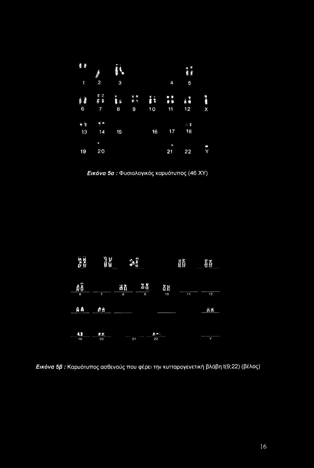 καρυότυπος (46 ΧΥ) II 18 >1 5ϋ gj *1 as If,... IK 6 7 8 9 10 1 1 12 ft A Aft a* Μ._.