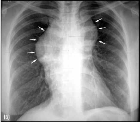 Τομογραφία Εκπομπής Ποζιτρονίων (PET/CT) Στο Λεμφωμα Hodgkin.