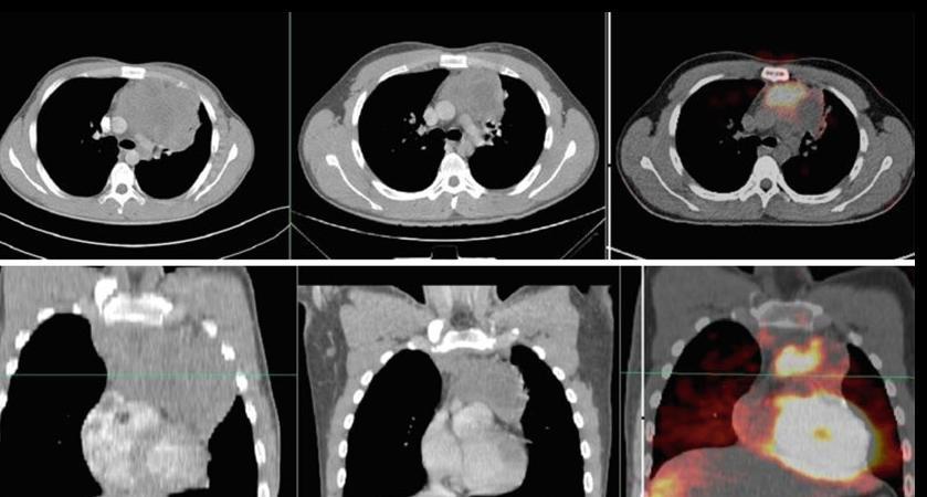 Τομογραφία Εκπομπής Ποζιτρονίων (PET/CT) Στο Λεμφωμα Hodgkin. Συσχέτιση με τη Θεραπευτική Στρατηγική και την Ακτινοθεραπεία ανάδειξη παρασπονδυλικής μάζας, από τον έλεγχο που έχει προηγηθεί με την CT.