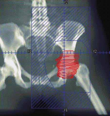 χώρα (β). [Hansen EK, Roach M III.Handbook of Evidence Based Radiation Oncology.