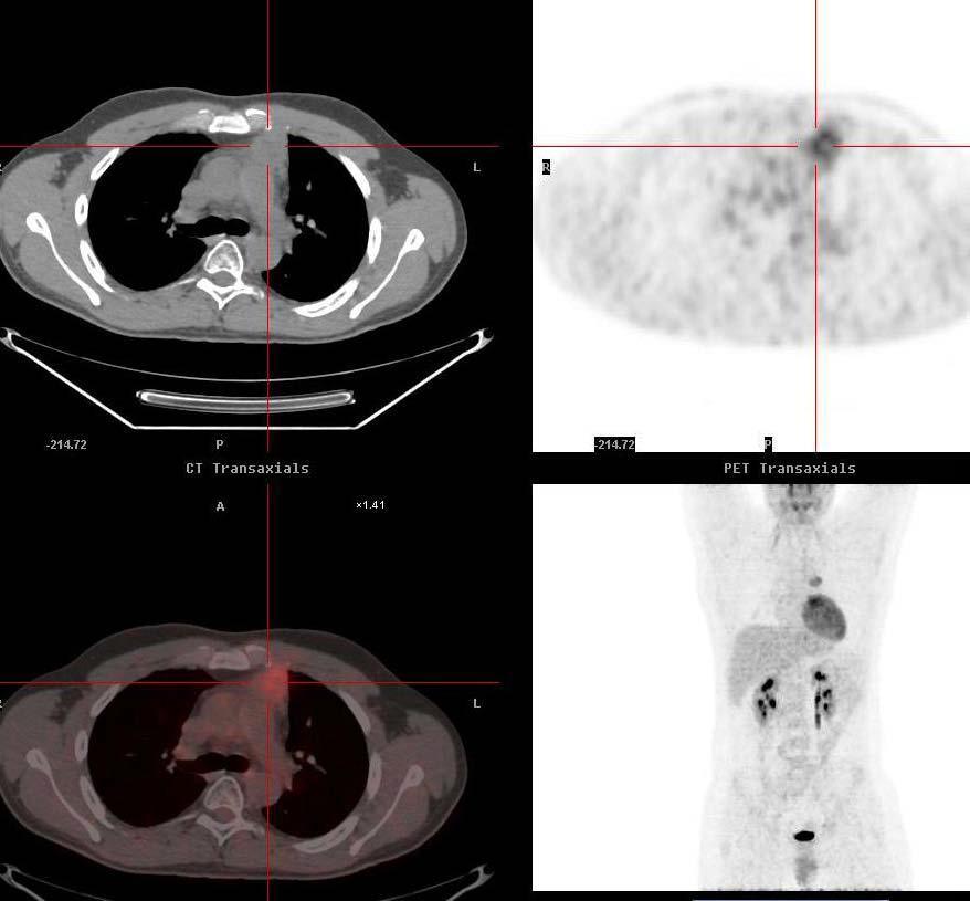 Τομογραφία Εκπομπής Ποζιτρονίων (PET/CT) Στο Λεμφωμα Hodgkin.
