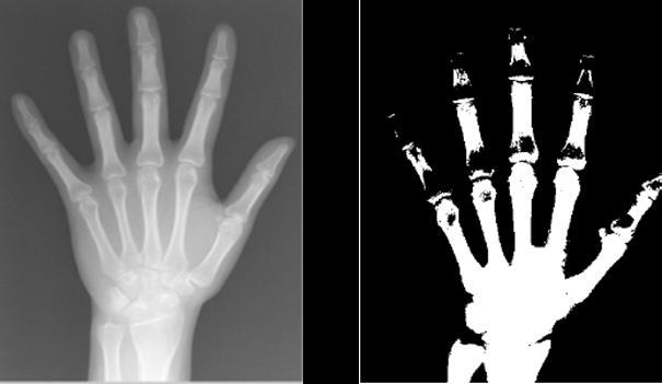 Παραδείγματος χάριν, μια ακτινογραφία μπορεί να βοηθήσει έναν ορθοπεδικό χειρουργό να αποφασίσει για το εάν ένα χέρι ή πόδι χρειάζεται να εγχειριστεί μετά από σοβαρό κάταγμα (Εικόνα 10), καθώς και