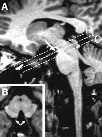 Arrows show the emergence of the third cranial nerve fibres.