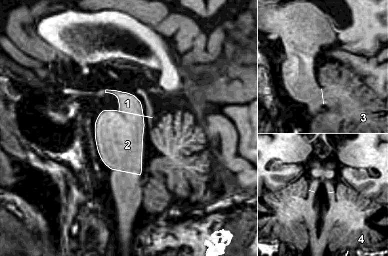 Sagittal and coronal T1-weighted volumetric spoiled gradient-echo MR images (15.2/6.8; section thickness, 0.
