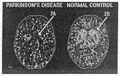 Πρέπει να υποπτευόμαστε νόσο Parkinson σε περιπτώσεις περιορισμού της κινητικότητας του ώμου, δυσχέρειας έγερσης από κάθισμα αυτοκινήτου, Δυσχέρεια αλλαγής πλευρού στο κρεβάτι, σκολίωσης, δυσκολίας