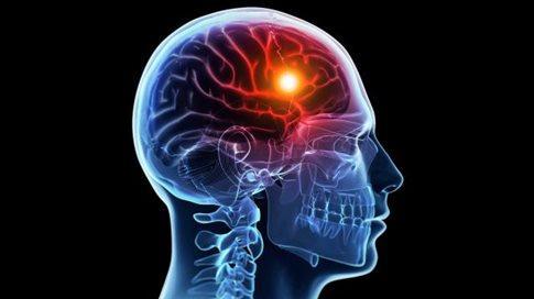 Εγκεφαλικό Το εγκεφαλικό συμβαίνει όταν υπάρχει αιμορραγία στον εγκέφαλο ή διακοπή της κανονικής ροής του αίματος στον εγκέφαλο.
