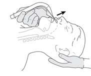 στο στόμα με το άλλο χέρι. (Εικόνα 4) 3. Πιέστε το περιφερικό άκρο στο εσωτερικό μέρος των δοντιών ή ούλων της άνω γνάθου. (Εικόνα 5) 4.