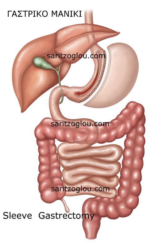 Επιμήκης Γαστρεκτομή (Γαστρικό Μανίκι Sleeve Gastrectomy) Το γαστρικό μανίκι ανήκει και αυτό όπως και ο γαστρικός δακτύλιος στις περιοριστικού τύπου βαριατρικές επεμβάσεις.