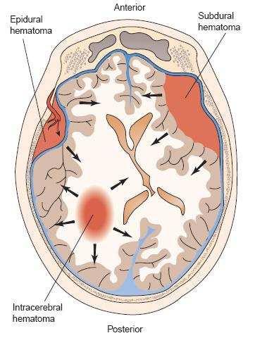 Εικόνα 6. Επισκληρίδιο και υποσκληρίδιο αιµάτωµα (www.nodrenergi.org) Εγκεφαλική διάσειση. Η εγκεφαλική διάσειση είναι η ηπιότερη µορφή κρανιοεγκεφαλικής κάκωσης και δεν περιλαµβάνει µόνιµη βλάβη.