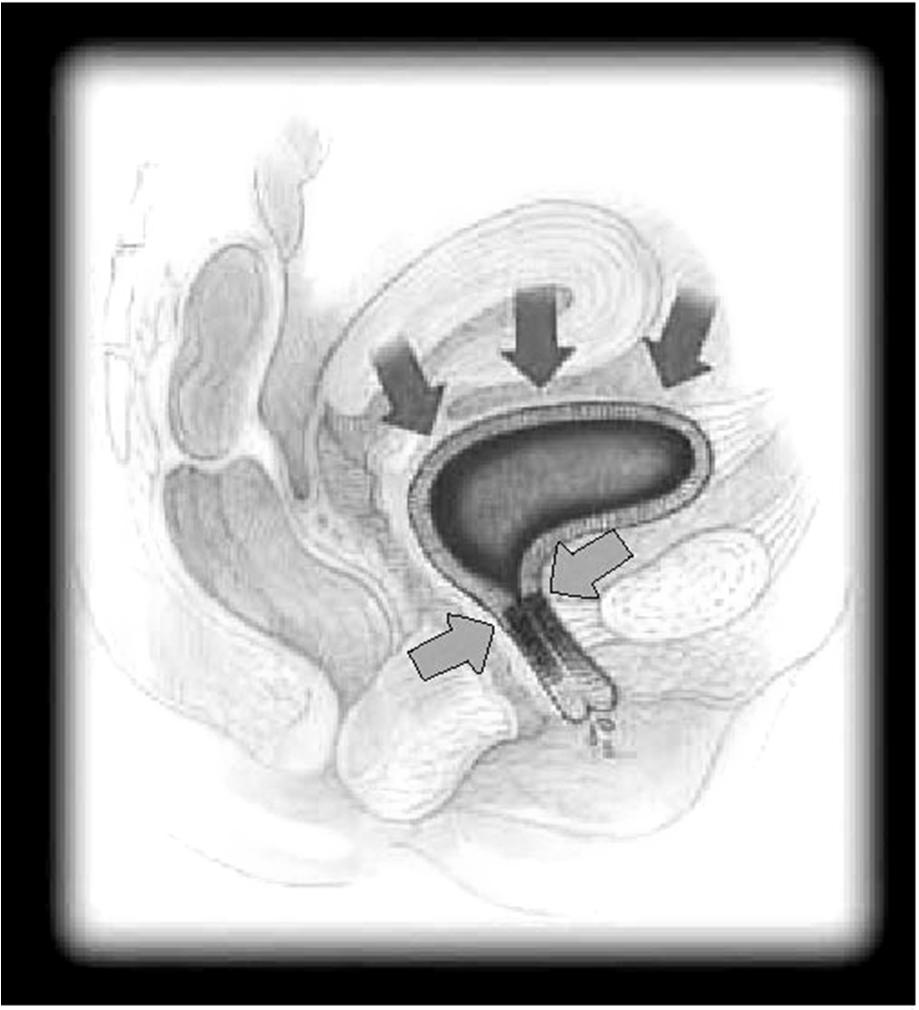 Μηχανισμός ακράτειας ούρων από προσπάθεια Υπερκινητικότητα ουρήθρας Μετατόπιση της ουρήθρας και του αυχένα της κύστης κατά την αιφνίδια αύξηση της κοιλιακής πίεσης εν επιτρέπει το κλείσιμο της