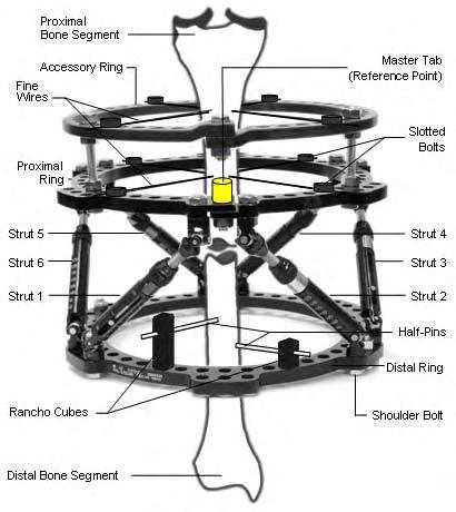 77 Παράρτημα Γ To πλαίσιο Taylor Spatial Frame Εικόνα 75: Πλαίσιο Taylor Spatial Frame (πηγή: http://www.bonefixator.