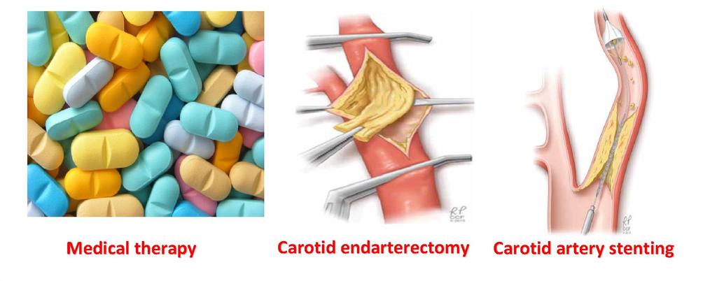 Carotid artery
