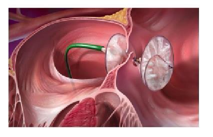 PFO occlude