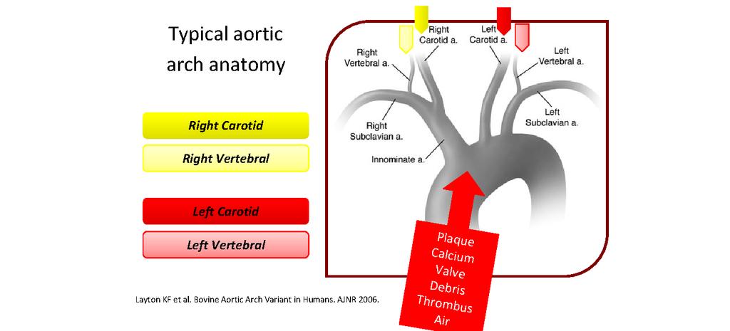 Embolic brain