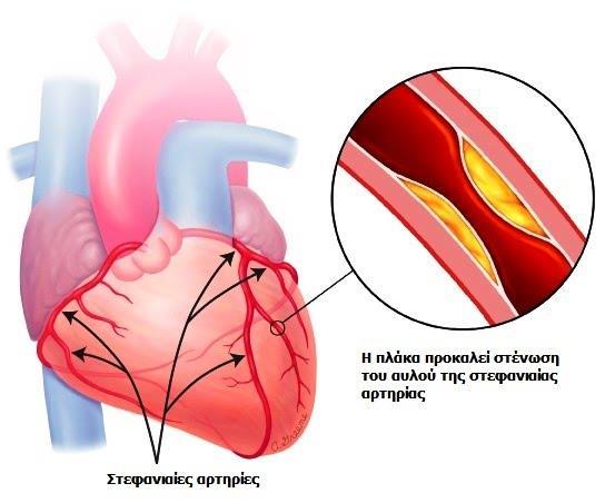 Η στένωση των στεφανιαίων αρτηριών γίνεται από το σχηματισμό μιας πλάκας (αθήρωμα) στο τοίχωμα της αρτηρίας.