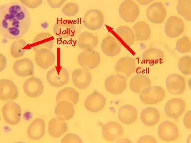 σωμάτια HOWELL JOLLY (υπόλειμα πυρηνικής