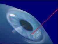 Τα laser αυτά εκπέμπουν σε μήκη κύματος που ανήκουν στο υπέρυθρο φάσμα, στα 1053 nm, όπου σε συνδυασμό με τη μικρή ενέργεια και το βραχύ χρόνο επιτρέπουν τη φωτοδιάσπαση του ιστού του κερατοειδή